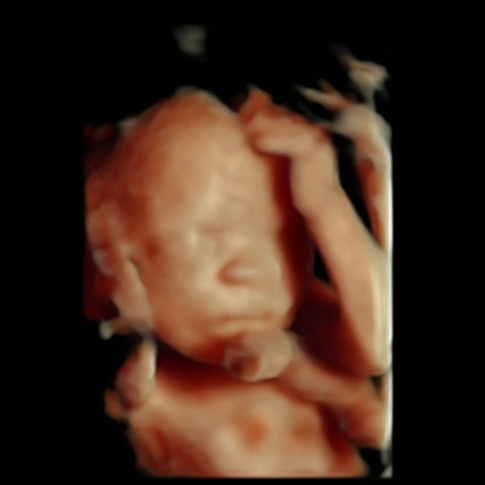 20 Week HD Live Ultrasound Image