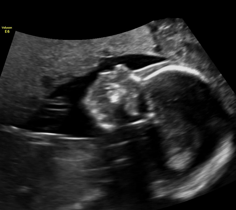 2D ultrasound face profile, lighter