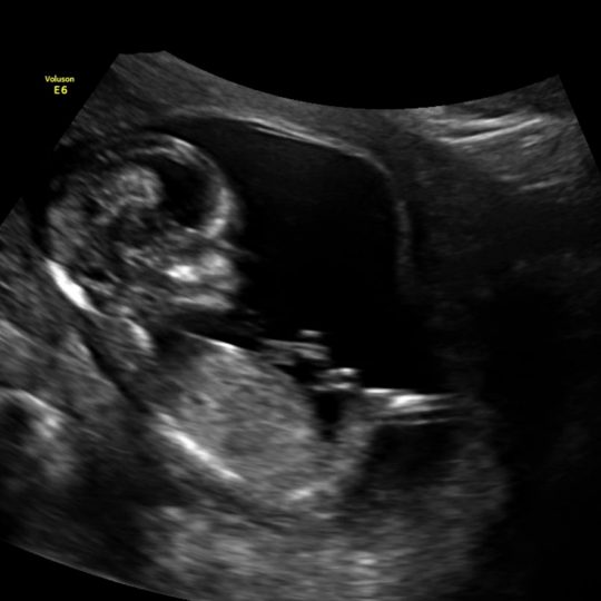 12 week 2d ultrasound