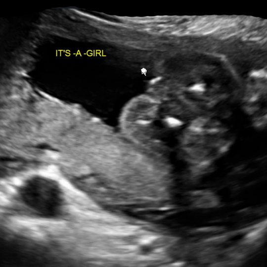 ultrasound photo baby girl