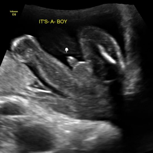 ultrasound photo of baby boy