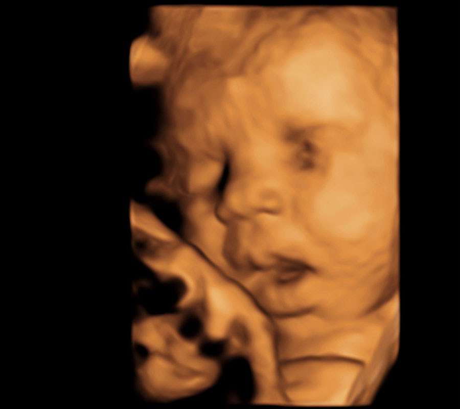 3D ultrasound image, mouth open