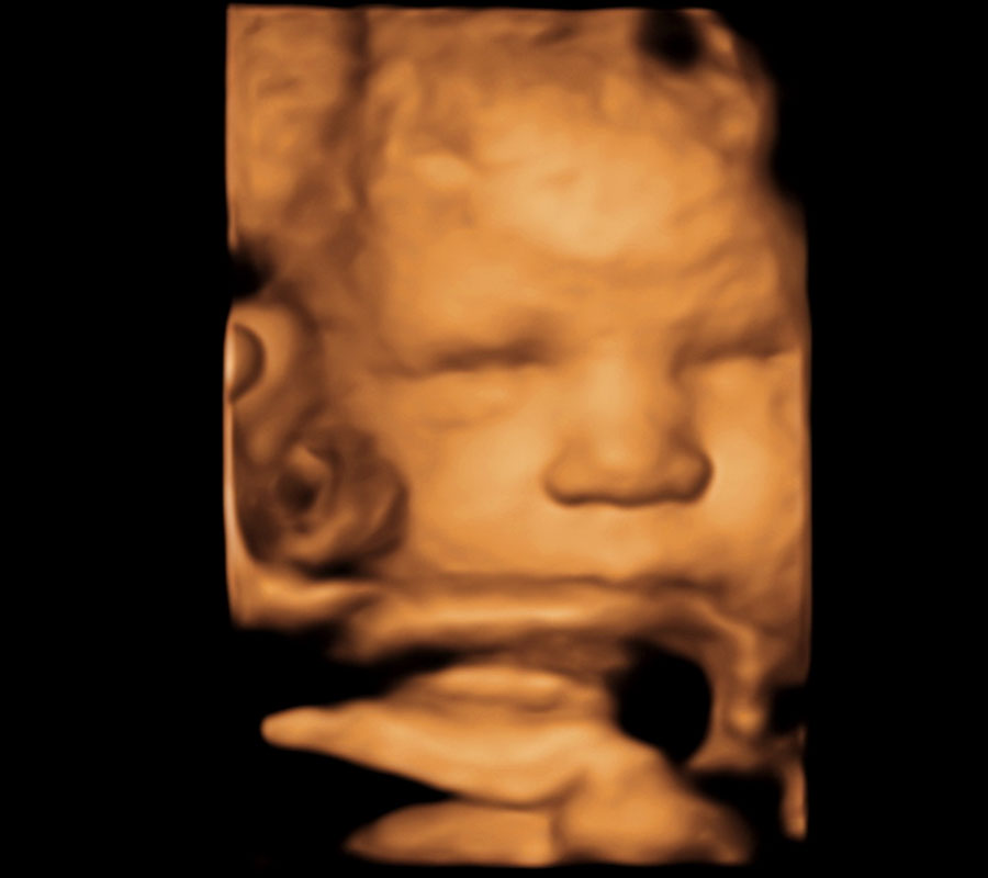 32 Week 3D ultrasound image