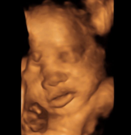 32 Week 3D Ultrasound Image