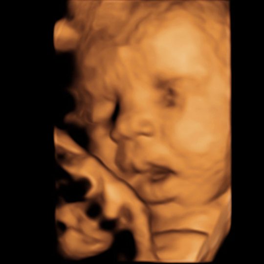 3d ultrasound image, open mouth