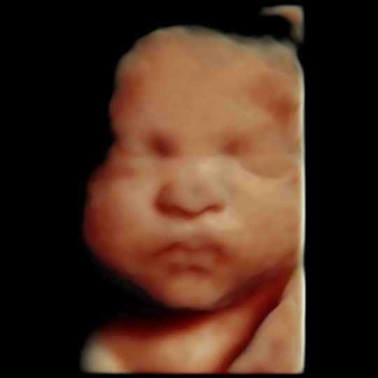 HD Live ultrasound image