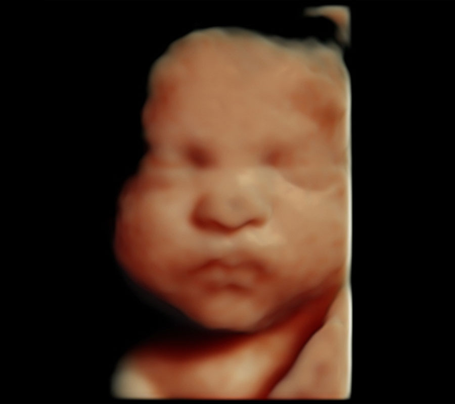 HD Live ultrasound image